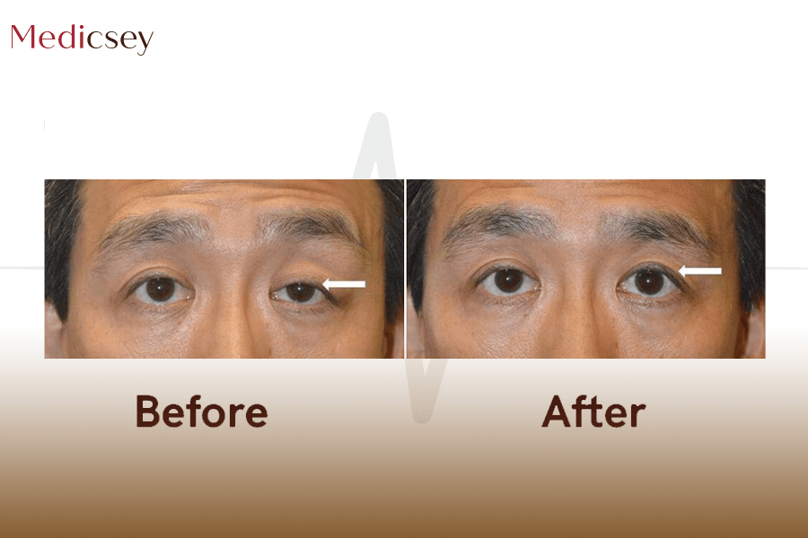 Ptosis online surgery cost